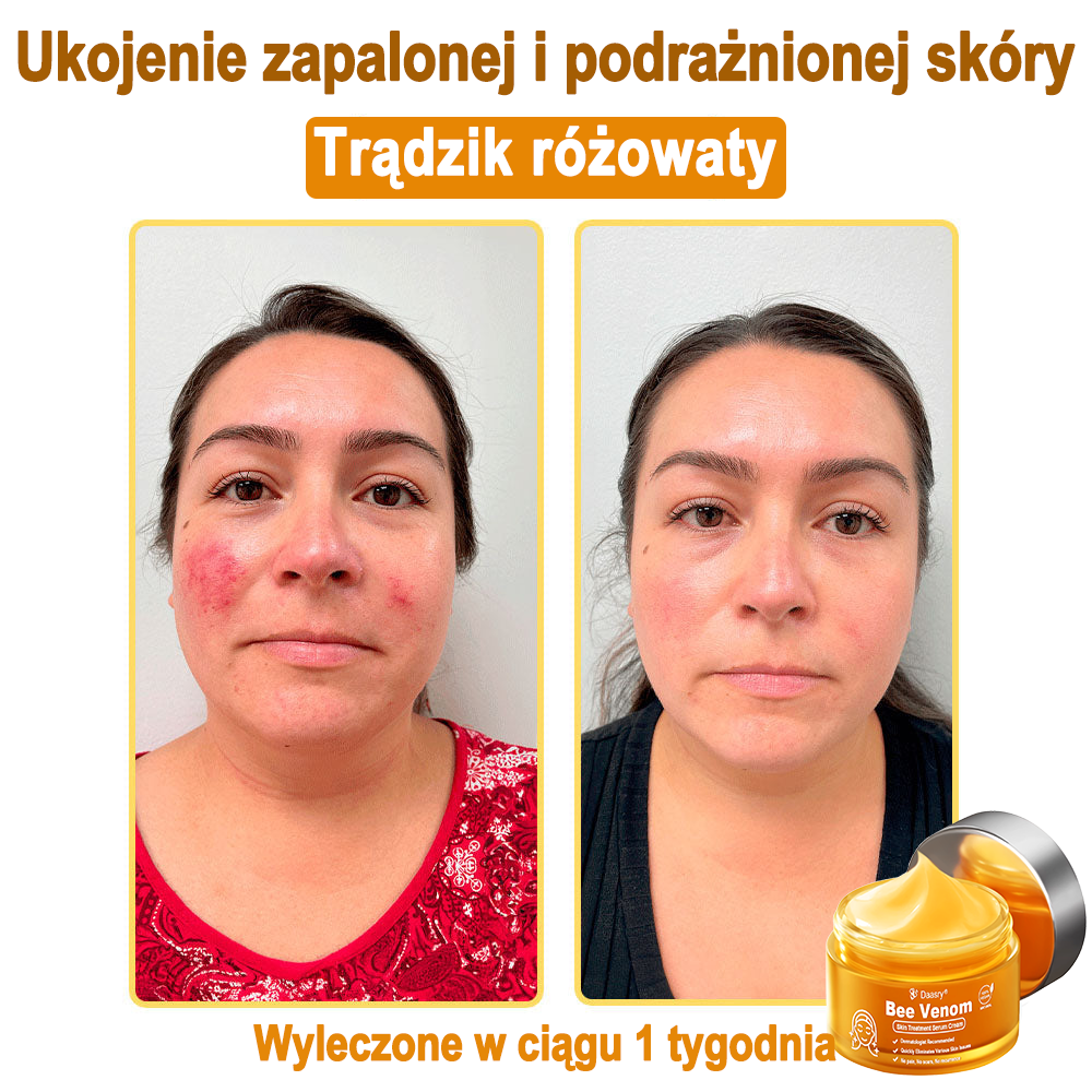 Daasry® 𝑩𝒆𝒆 𝑽𝒆𝒏𝒐𝒎 𝑺𝒌𝒊𝒏 𝑻𝒓𝒆𝒂𝒕𝒎𝒆𝒏𝒕 𝑺𝒆𝒓𝒖𝒎 𝑪𝒓𝒆𝒂𝒎👨⚕️ (Suitable for all ages & TGA recommends)