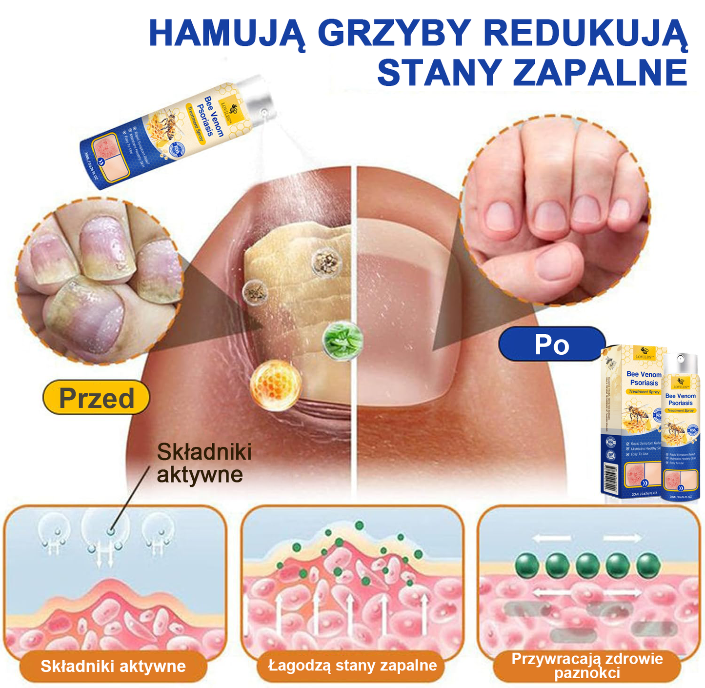 🔥Płatność przy odbiorze🔥60% zniżki) LOVILDS™ PsoriaHeal Spray na łuszczycę (wysyłka na cały świat – bezpłatna wysyłka