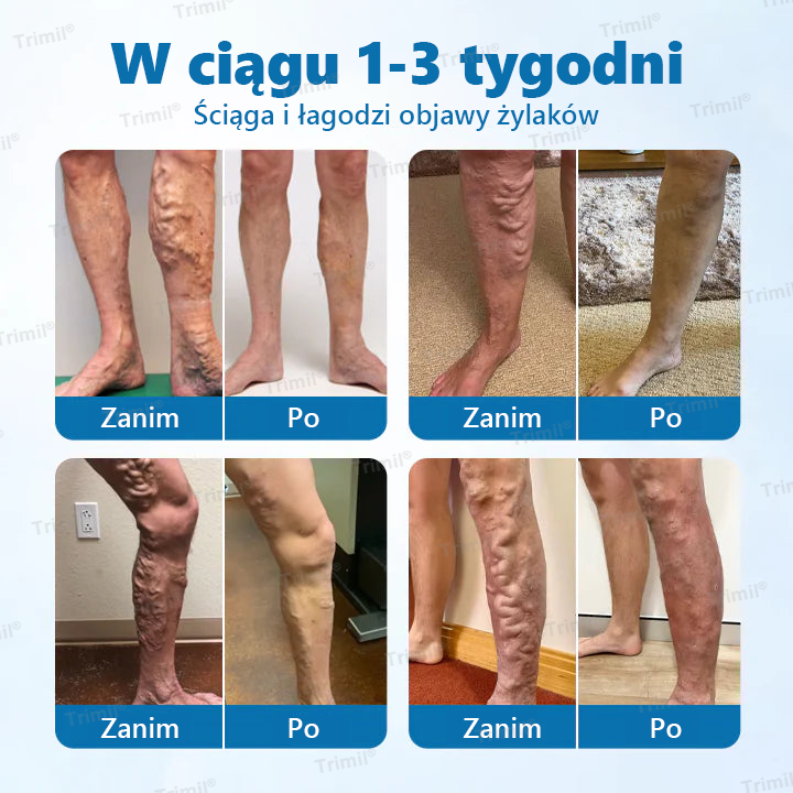 Trimil® Spray Ziołowy na Żylaki – Szybka Ulga, Klinicznie Potwierdzona Skuteczność