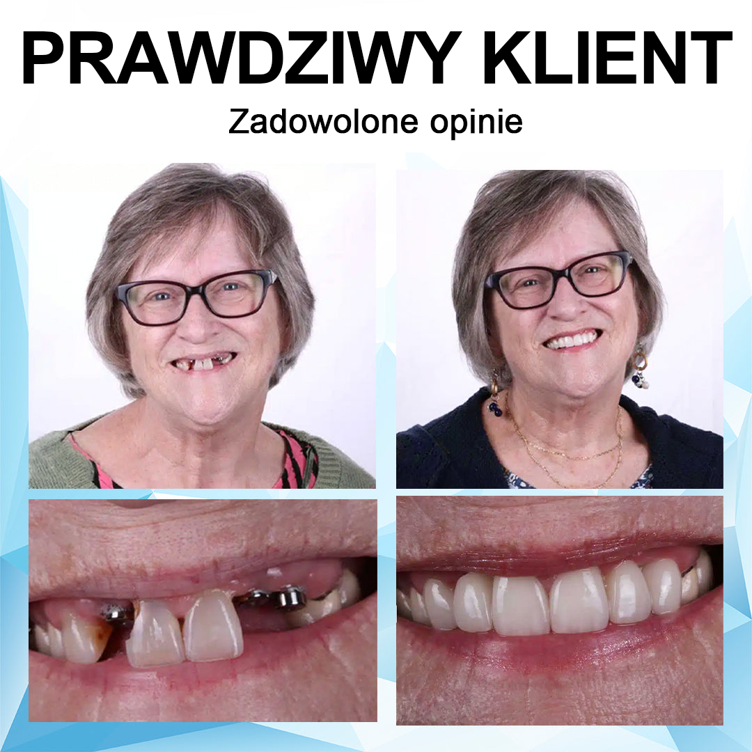 👨⚕🦷 Furzero™Regulowana proteza - najlepsza alternatywa dla drogich aparatów ortodontycznych!🥰