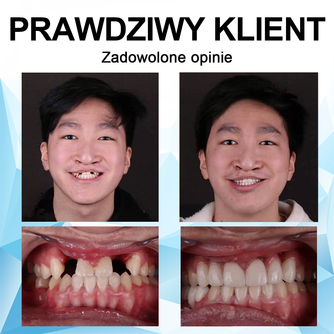 👨⚕🦷 Furzero™Regulowana proteza - najlepsza alternatywa dla drogich aparatów ortodontycznych!🥰