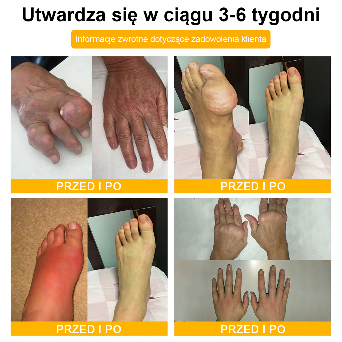 ✅ TLOPA® Przeciwbólowy krem wspierający regenerację kości z toksyną botulinową i jadem pszczelim 🐝🐝