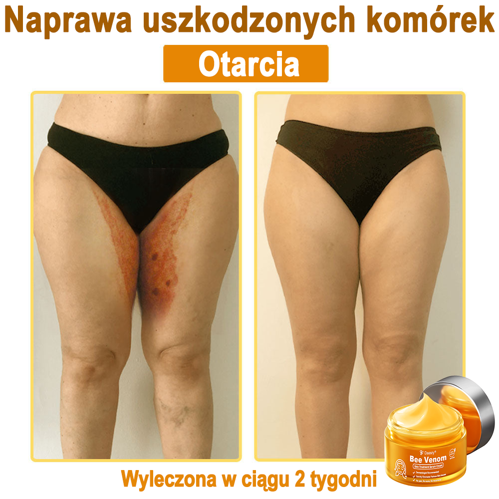 Daasry® 𝑩𝒆𝒆 𝑽𝒆𝒏𝒐𝒎 𝑺𝒌𝒊𝒏 𝑻𝒓𝒆𝒂𝒕𝒎𝒆𝒏𝒕 𝑺𝒆𝒓𝒖𝒎 𝑪𝒓𝒆𝒂𝒎👨⚕️ (Suitable for all ages & TGA recommends)
