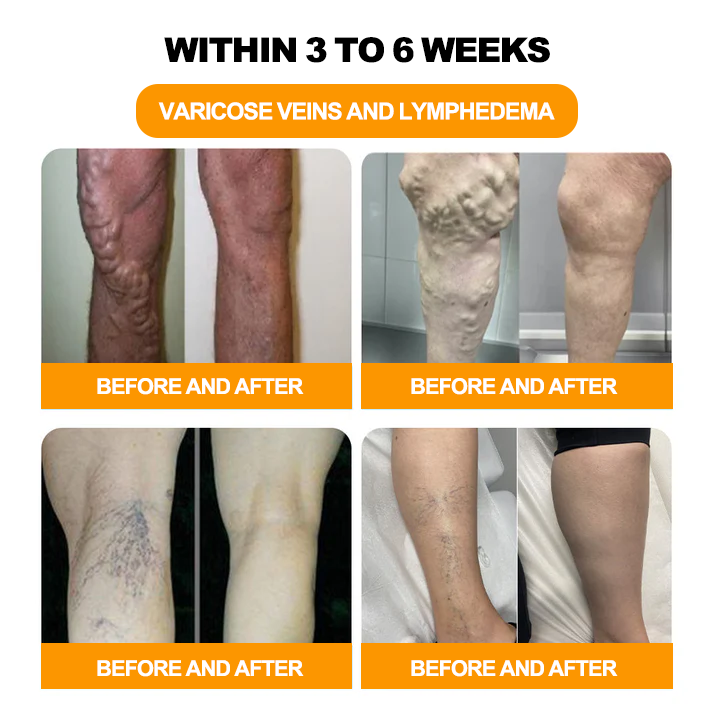 ⏰ RevivaFoot™ Mélthin krem do drenażu limfatycznego i pielęgnacji stóp zmniejsza obrzęk o 70%【Poprawa krążenia limfy - całkowite rozwiązanie problemów związanych z obrzękiem nóg】