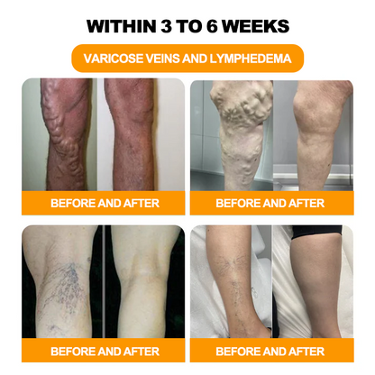 ⏰ RevivaFoot™ Mélthin krem do drenażu limfatycznego i pielęgnacji stóp zmniejsza obrzęk o 70%【Poprawa krążenia limfy - całkowite rozwiązanie problemów związanych z obrzękiem nóg】
