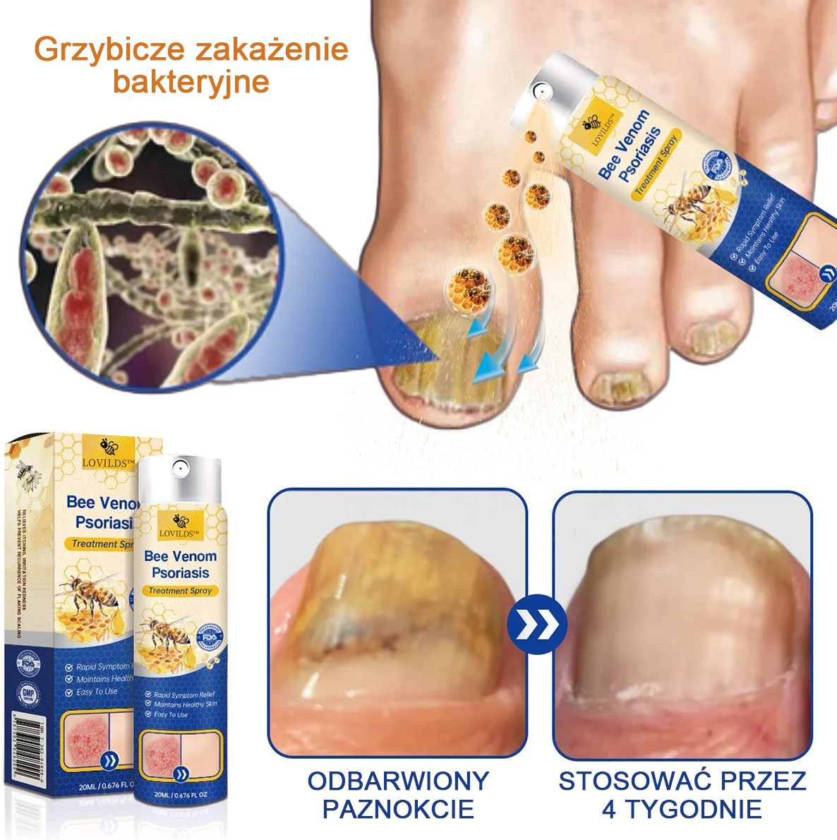 🔥Płatność przy odbiorze🔥60% zniżki) LOVILDS™ PsoriaHeal Spray na łuszczycę (wysyłka na cały świat – bezpłatna wysyłka