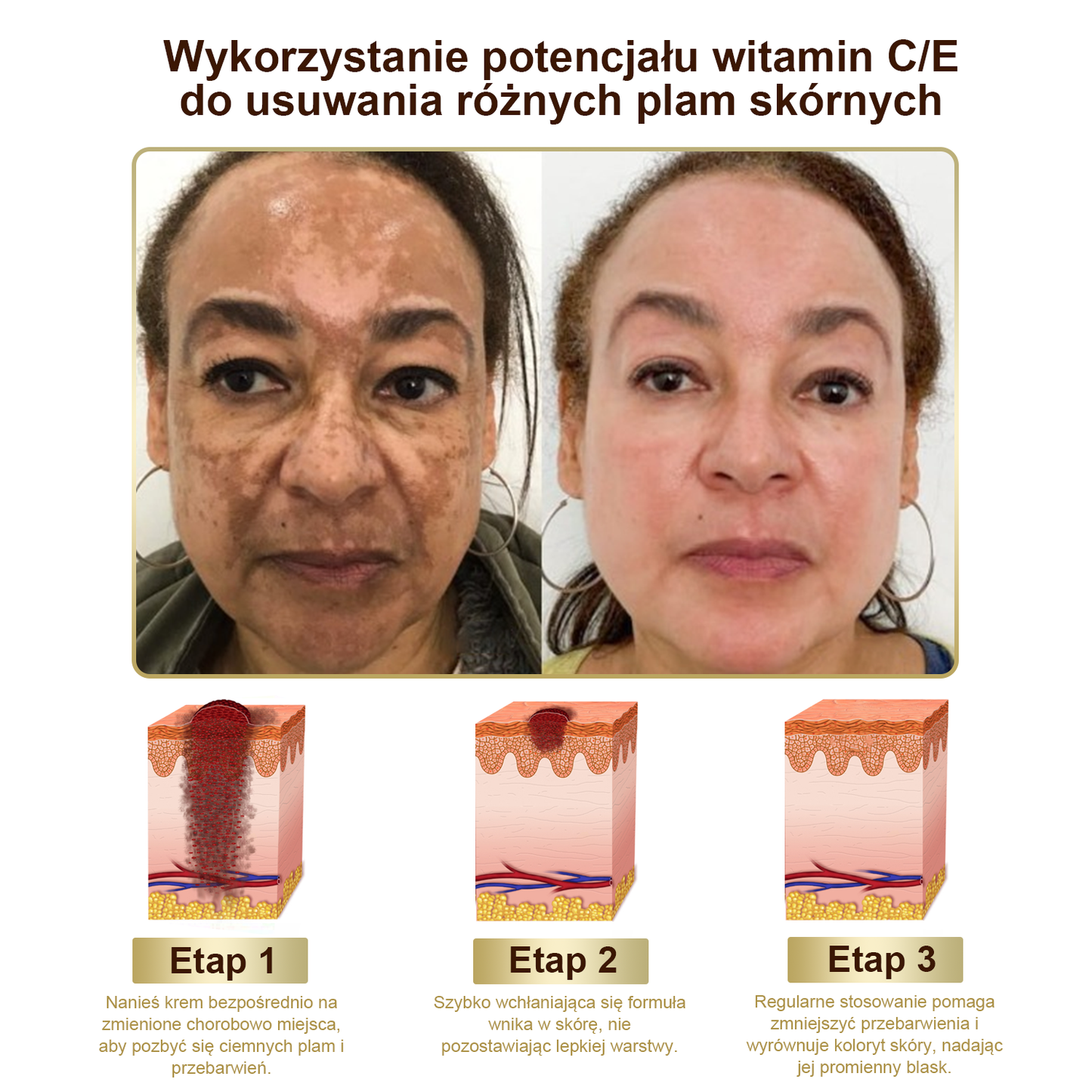 Płatność przy odbiorze 💰 PLTOWE® Krem z jadem pszczelim na kurzajki i pieprzyki 🐝 (👨‍⚕Zalecany przez dermatologów AAD) 🔥 Ostatni dzień promocji – 70% taniej!