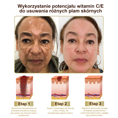 Płatność przy odbiorze 💰 PLTOWE® Krem z jadem pszczelim na kurzajki i pieprzyki 🐝 (👨‍⚕Zalecany przez dermatologów AAD) 🔥 Ostatni dzień promocji – 70% taniej!