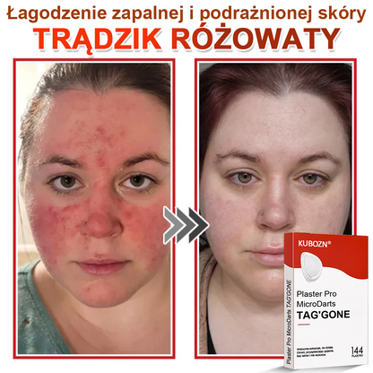 🌈 KUBOZN® Mikroigłowy Botaniczny Plaster na Usuwanie Brodawek Skórnych
