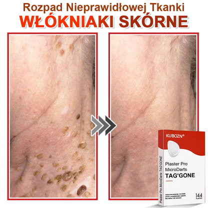 🌈 KUBOZN® Mikroigłowy Botaniczny Plaster na Usuwanie Brodawek Skórnych